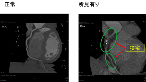 実際の検査で得られた右冠動脈の画像